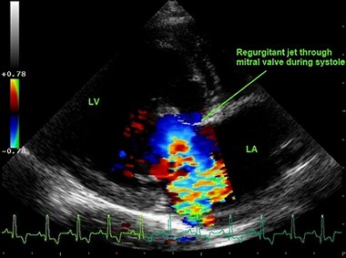 Cardiac ultrasound showing a leaking heart valve using colour doppler
